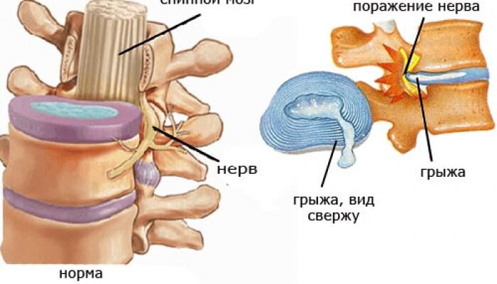 Может ли грыжа позвоночника исчезнуть без операции?