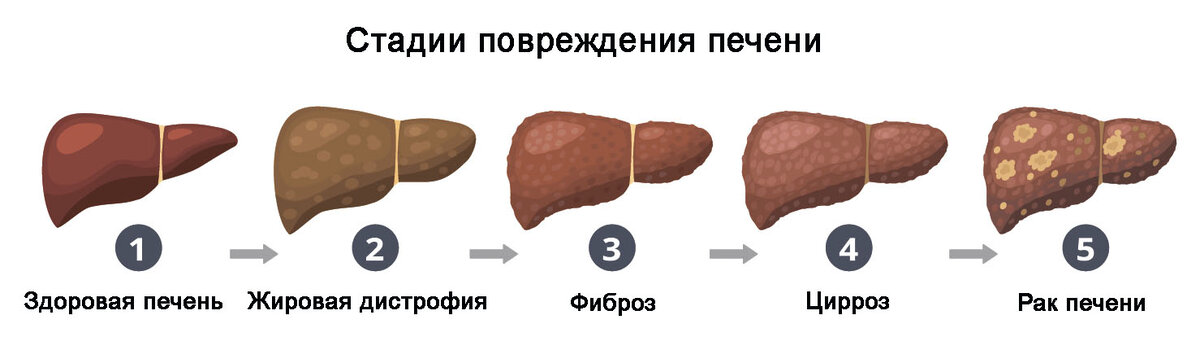 Фиброз печени картинки