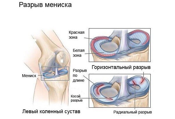 Повреждения мениска коленного сустава