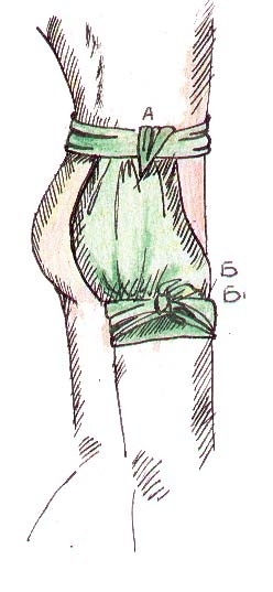 Повязка косынкой ягодичной области. При перевязке ягодичной области в верхней части бедра верхушка косынки А прикрепляется к поясу, проведенному вокруг талии, середина ее лежит на ягодице, основание В огибает верхнюю часть бедра, причем концы Б и Б1, обведенные вокруг бедра, завязывают на наружной стороне бедра.