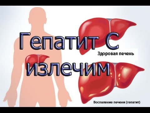 Вылечить Гепатит С бесплатно                                                                                                           Рассекречиваем алгоритм получения бесплатного лечения гепатита С.
                В России гепатит С лечится интерферонными  и безинтерфероновыми препаратами и это совсем не те препараты которые рекламируют по ТВ. Современные трехкомпонентные интерферонная и безинтерфероновые схемы способны вылечить почти 100% инфицированных. Интерферонная терапия первого поколения состоящая из двух компонентов интерферона и рибавирина эффективна для 40–80% больных, а по своему воздействию на организм похоже на химиотерапию. Бесплатное лечение гепатита С гарантированно государством, а исполнение этих обязательств возложили на регионы. Приглашение на прохождение бесплатного лечение не ждите, более того для решения этого вопроса надо приложить усилие. Возможно вам потребуется немного скорректировать предложенную дорожную карту под особенности вашего региона. Но основа везде одна, независимо в каком субъекте РФ вы проживаете. 
          Начнем, у вас диагностировали гепатит С. Диагноз  его выявляет анализ крови методом ПЦР и он означает, что вирус гепатита С в организме присутствует. Насколько он пагубно уже повлиял и насколько он развязанно себя ведет пожирая печень в данный момент по данному анализу сказать нельзя.
            Во - первых, заведите себе папочку для хранения копий результатов обследований.  Результаты обследований могут быть не актуальны для определения вашего текущего состояния, но показывают динамику протекания заболевания и пригодится для обоснований почему именно вам срочно требуется лечение. Если вирус гепатита С выявлен вас автоматически ставят на учет к врачу-инфекционисту.  Если в поликлинике по месту жительства такого врача нет, то такой учет ведет участковый терапевт. Записываемся к врачу. Обязательный учет заключается в систематическом прохождении пациентом ниже приведенного перечня обязательных обследований. 
    1.	Общий анализ крови + тромбоциты (в мазке), актуален 1 месяц;
    2.	Биохимический анализ крови, включающий АЛТ, АСТ, ГГТП, ЩФ, альбумин, билирубин + фракции, мочевину, креатинин, холестерин, глюкозу, мочевую кислоту, актуален 2 месяца.                                                                                                                                                                             АЛТ, АСТ, билирубин - являются основными показателями по которым можно судить на сколько ожесточенно вирус вас атакует в данный момент. Если отклонений от норм нет, значит он временно спит, а ваша печень и организм в целом не изношены и способен ему противостоять. При таких показателях можно с уверенностью сказать следующее: человек не  употребляет алкоголь и скорее всего придерживается ЗОЖ.
     3.	HCV RNA генотипирование – (срок давности неограничен). Гепатит С имеет 6 «расовых» принадлежностей - генотипов. В соответствии с генотипом будет выбрана схема лечения. Самый вредный 1b.
    4.	УЗИ органов брюшной полости с данными об асците, тромботических масс и объемных образованиях печени, актуально 6 месяцев;
    5.	Эластография печени, актуальна 12 месяцев. Это специальное УЗИ печени позволяющее определить степень фиброза, т.е какой процент печени уже съеден вирусом. Все их четыре, при фиброзе 4/F степени поставят диагноз цирроз. 
   6.	Эзофагогастродуоденоскопия.  Детальное исследование пищевода, желудка и двенадцатиперстного кишечника. Если вы точно знаете, что с пищеварительной системой все в порядке, можно подождать. Но лучше подстраховаться и пройти, чтобы своевременно выявить и устранить возможные преграды, т.к только здоровому желудку дадут терапию.

          Для пациентов с диагнозом  гепатита С перечисленные обследования проводится в рамках ОМС, т.е бесплатно, кроме одного - определение генотипа. Но можно встретить регионы, где и генотип можно определить бесплатно, например в Забайкальском крае.
       Часть обследований вы пройдете в поликлиники, а на остальную часть врач выпишет направление в гепатологический центр. Как правило это генотипирование и эластография, а если направление выписывает терапевт, то он выпишет направление и к инфекционисту, принимающий в центре. В случае если центр находится в другом районе, где вы проживаете вам выпишут направление на бесплатный проезд для центре социальной защиты населения.                                                                                                                                                                        Практически во всех субъектах РФ функцию гепатологического центра вменяют  Центру Спида или центральной инфекционной больнице, а иногда и гастроэнтерологическому отделению в центральной больнице региона. Обязательно свяжитесь с центром самостоятельно и выясните особенности приема пациентов по направления (записи на прием, требования к направлениям).
Заключение по результатам обследования дает инфекционист. В заключение может звучать одна из формулировок: «требуется лечение» и «экстренное лечение не требуется».
             Резолюцию «Не требуется» получат пациенты с 0F -1F степенью фиброза. В этом случае алгоритм по получению бесплатного лечения будет следующий.
           1.	Контроль за своевременной актуализацией результата обязательных обследований. Контроль за актуальность показателя АЛТ, АСТ и билирубина, позволит вам вовремя увидеть активизацию вируса и снизить его влияние за счет приема гепатопротекторов, перехода на рекомендованное питания, исключения алкоголя и др. пагубных привычек.
          По актуальной эластография, т.е степени фиброза определяет остаетесь  ли вы в группе «не нуждающихся» или уже пора получать новое заключение инфекциониста.
         2.	Вы направляете обращения, соблюдая субординацию (главный врач района – министерство здравоохранения региона – губернатор – министерство здравоохранения РФ – президент РФ). В обращении вы описываете кратко вашу историю, в том числе и результаты ранее направленных обращений, приводите доводы почему вам необходимо провести лечение. Доводы могут быть разные, например, вы многодетный или одинокий родитель и т.п. 
         Пациентам с резолюцией «Требуется лечении» необходимо попасть на прием к специалисту ответственному за ведение регионального реестра пациентов, которым нуждаются в лечении гепатита С. Зачастую это участковый терапевт. По истечении времени уточните ваш номер в реестре. И в дальнейшем нужно руководствоваться тем же алгоритмом, что и группа не нуждающихся в экстренном лечении.
         Для пациентов с 1b генотипом и степенью фиброза 2F b и выше возможно совершенно бесплатно вылечить гепатит С современной безынтерфероновой терапией в гепатологический клиниках  Красногорска, Мытищах, Домодедово,    Подольска и Щелково Московской области, а также в Коломне, Твери и Самаре за счет средств обязательного медицинского страхования (ОМС) – бесплатно. Первое условие – регистрация по месту жительства за пределами области, где расположена клиника.                                                                                                  Клиническая больница №1 МЕДСИ в Отрадном (г. Красногорск Московской области) принимает  на безинтерфероновую  терапию хронического вирусного гепатита С генотипы 1,2,3,4 (за исключением пациентов, зарегистрированных в Москве).
     Число таких клиник, занимающиеся межбюджетными трансфертами в рамках ОМС с каждым днем растет. Найти и связаться с ними легко в интернете. В этом случаи специалисты клиник помогут вам составить дорожную карту. 
 
