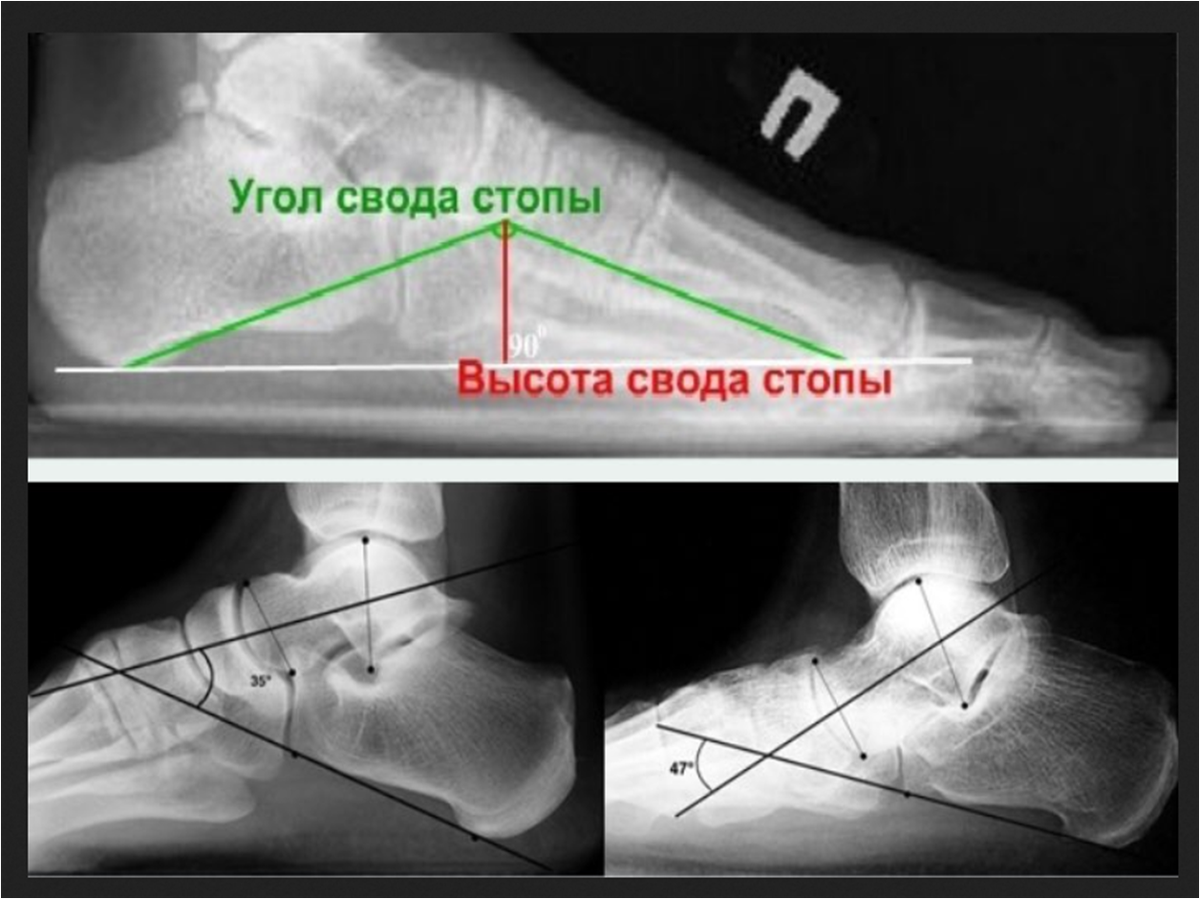 Рентгеновская диагностика наличия или отсутствия плоскостопии