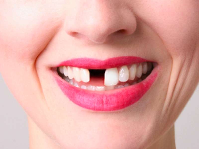 Почему выпадают зубы у взрослых