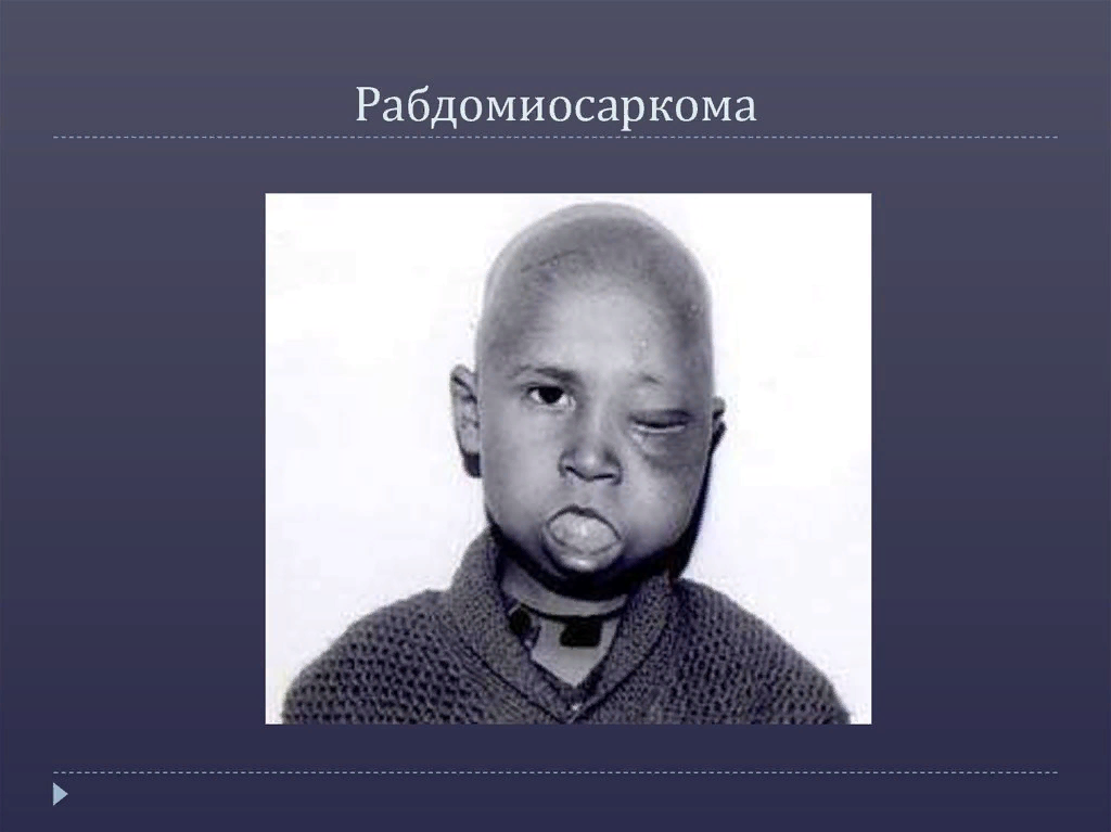 Рабдомиосаркома мягких тканей на узи фото