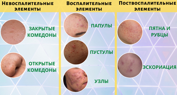 Закрытые комедоны - белые точки, небольшие "выпуклости", это кожное сало под ороговевшей кожей.                                                                                                                              Открытые комедоны (черные точки) - окисленное кожное сало.                                            Папулы - покраснения без содержимого.                                                                                             Пустулы - сформированные гнойные стержни.                                                                        Экскориация - нарывы, которые образуются при самостоятельном удалении прыща.