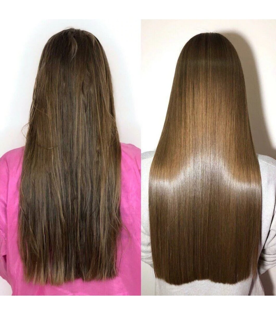 До и после применения Ботокса