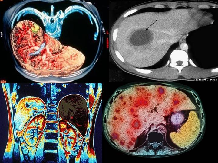Рак брюшной полости. Кт брюшной полости цирроз печени. Магнитно-резонансная томография печени. Магнитно-резонансная томография печени цирроз. Компьютерная томография кт цирроз печени.