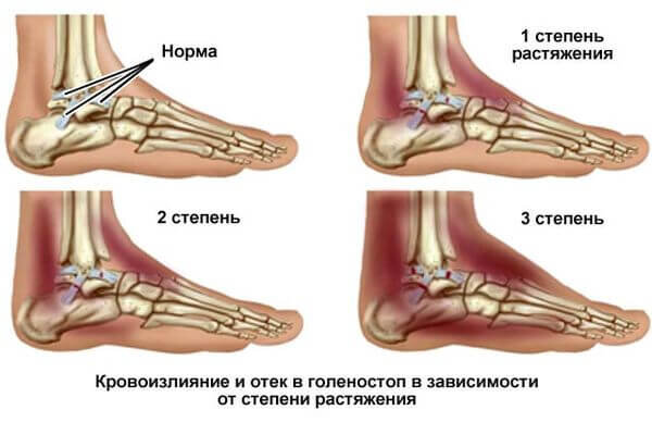 Растяжение связок голеностопа