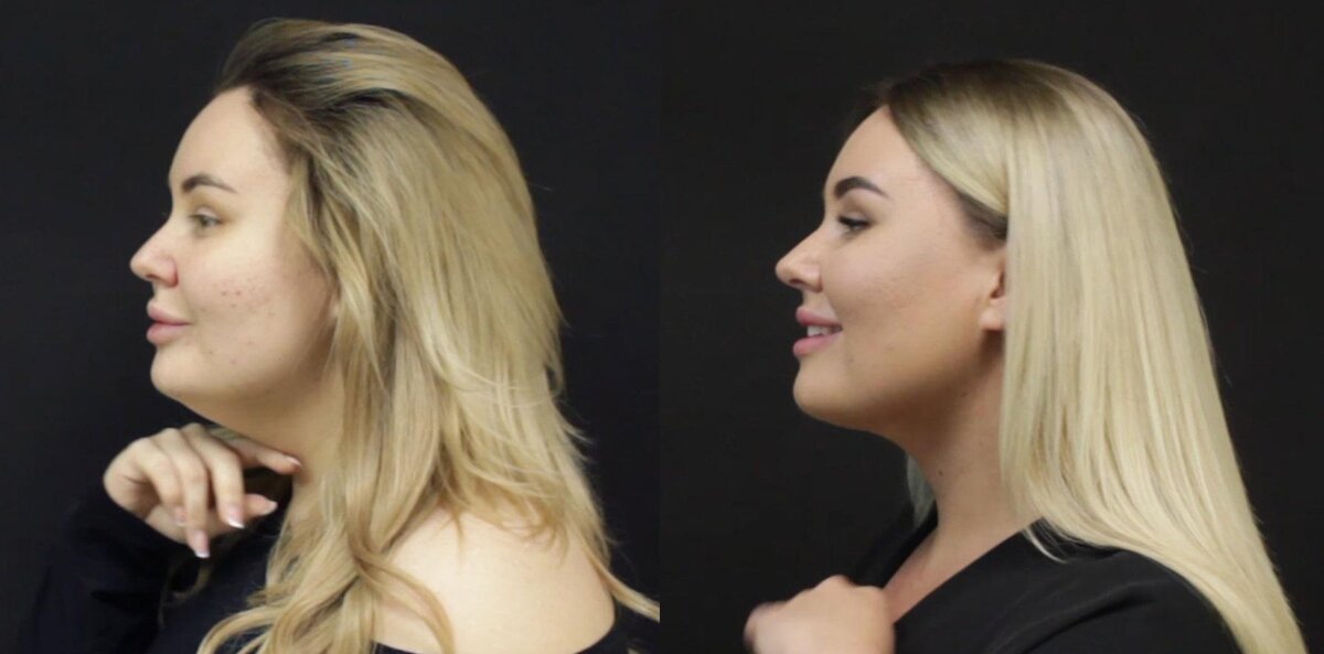 Липосакция подбородка. Фото взято из открытого источника. Имеются противопоказания, требуется консультация специалиста.