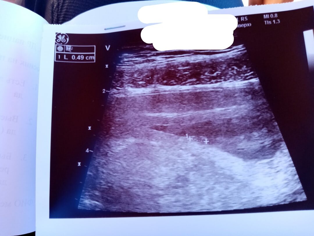 УЗИ 7 недель