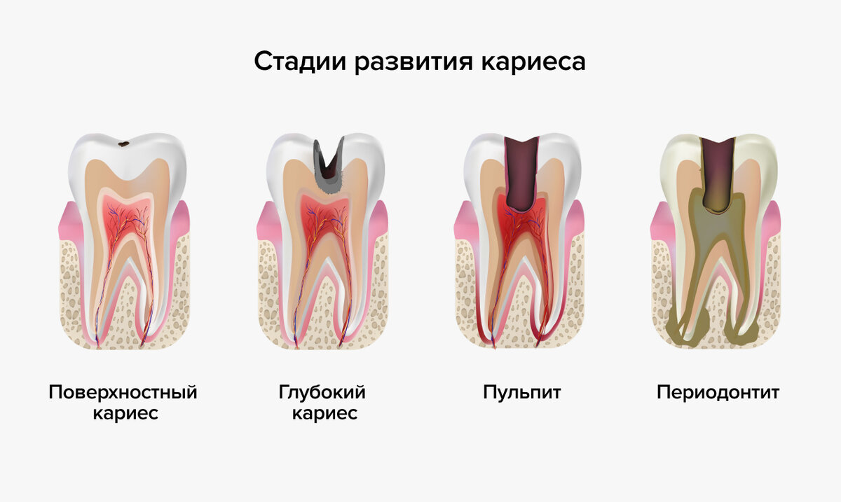 Чем раньше вы заметите кариес, тем проще будет его лечение. 