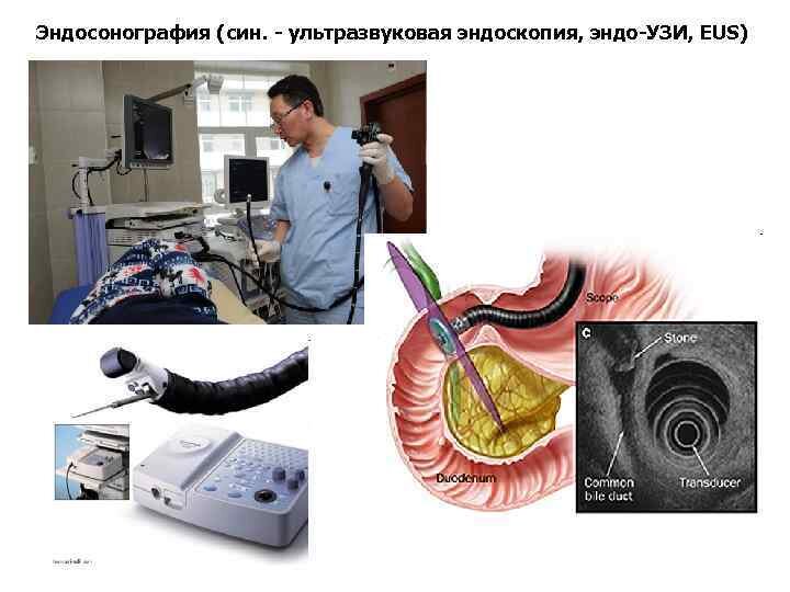 Эндосонография желудка – новейший метод ультразвукового исследования органа с применением эндоскопа, отображающее пятислойную структуру стенок желудка изнутри. Метод используется для дифференциальной диагностики опухолевых, язвенных и воспалительных поражений слизистой оболочки, эпителиальных и внутристеночных новообразований, экстраорганного сдавливания желудка. 