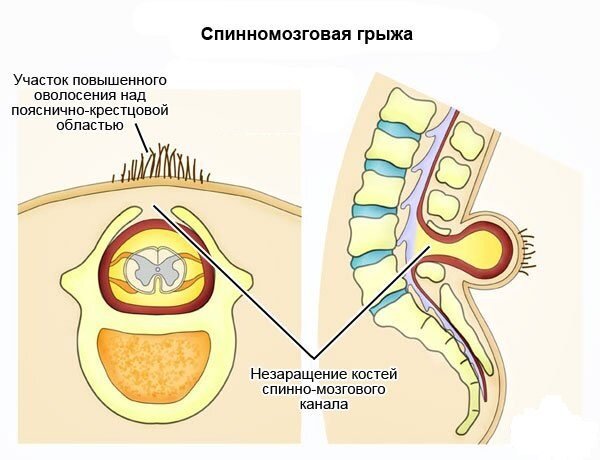 Спинномозговая грыжа - это врожденный порок