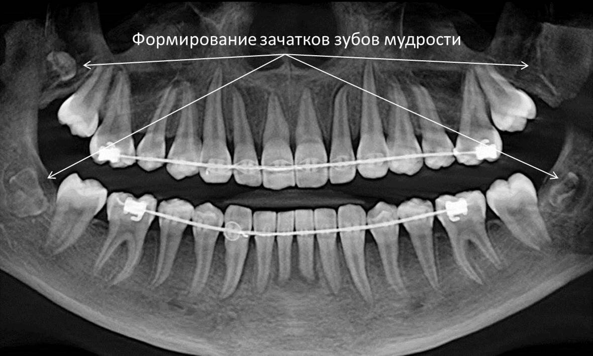 Нужно ли удалять зубы мудрости | . | Дзен