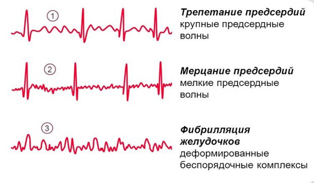 ЭКГ: описание, норма и признаки патологий