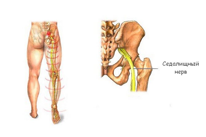 Седалищный нерв где находится фото у мужчин