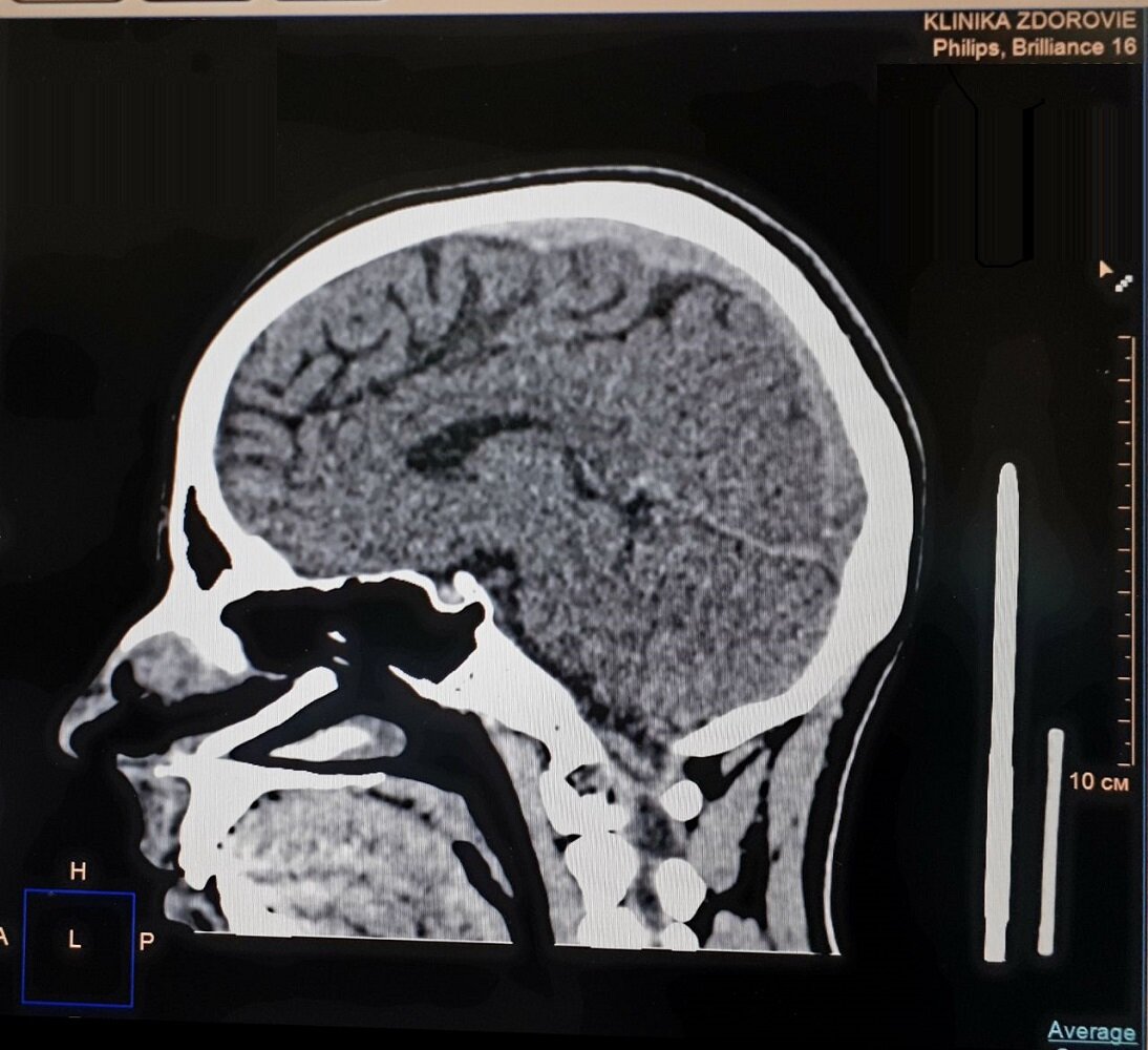 КТ головы: что показывает и кому назначают? | Клиника Здоровья | Дзен