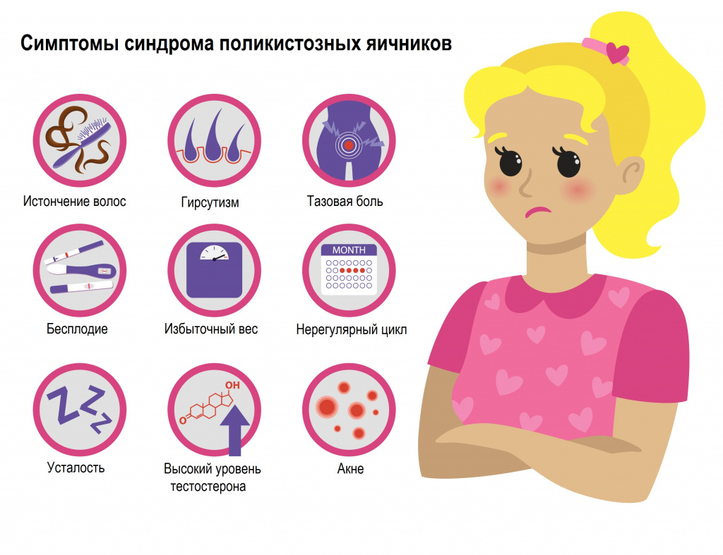 Лечение поликистоза яичников у девушек. Поликистоз яичников симптомы. Синдром поликистоз яичников. Препараты от поликистоза яичников. Спкя клиническая картина.