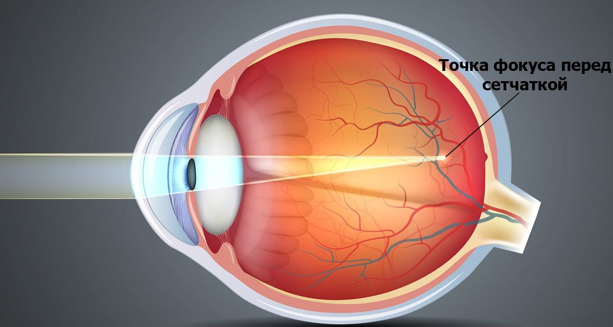 Близорукость какое глазное яблоко