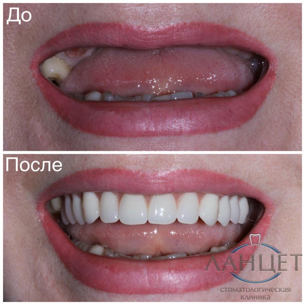 Мы фотографируем зубы до и после для объективности оценки результата, так что всё по-честному. 

