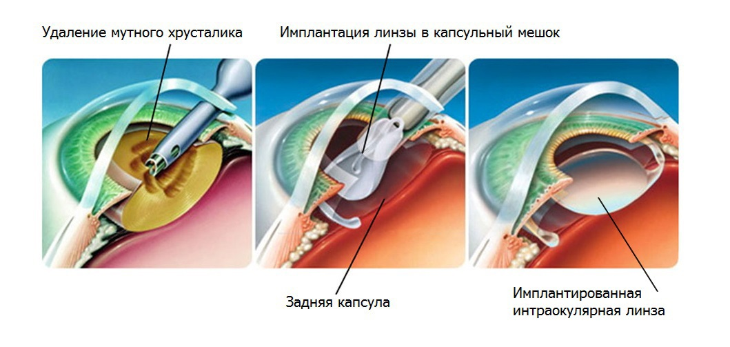 Катаракта операция хрусталик. Факоэмульсификация катаракты с имплантацией. Операция ультразвуковая факоэмульсификация катаракты. Этапы операции факоэмульсификации катаракты.