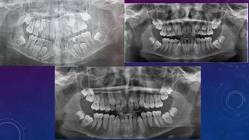 Благодаря своевременному последовательному удалению временных зубов удалось избежать нарушений прикуса.