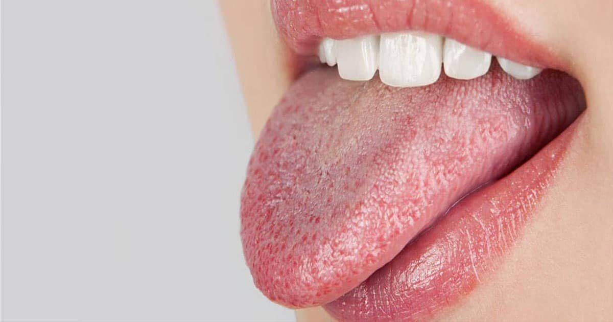 ксеростомия(мало слюны)