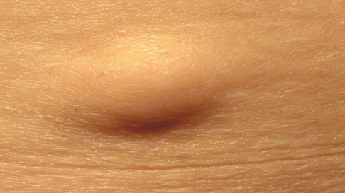 Шишка на бедре под кожей: возможные причины и особенности лечения