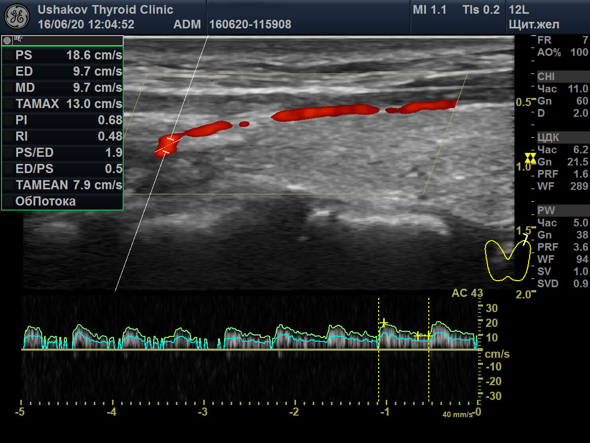 высокорезистентный кровоток