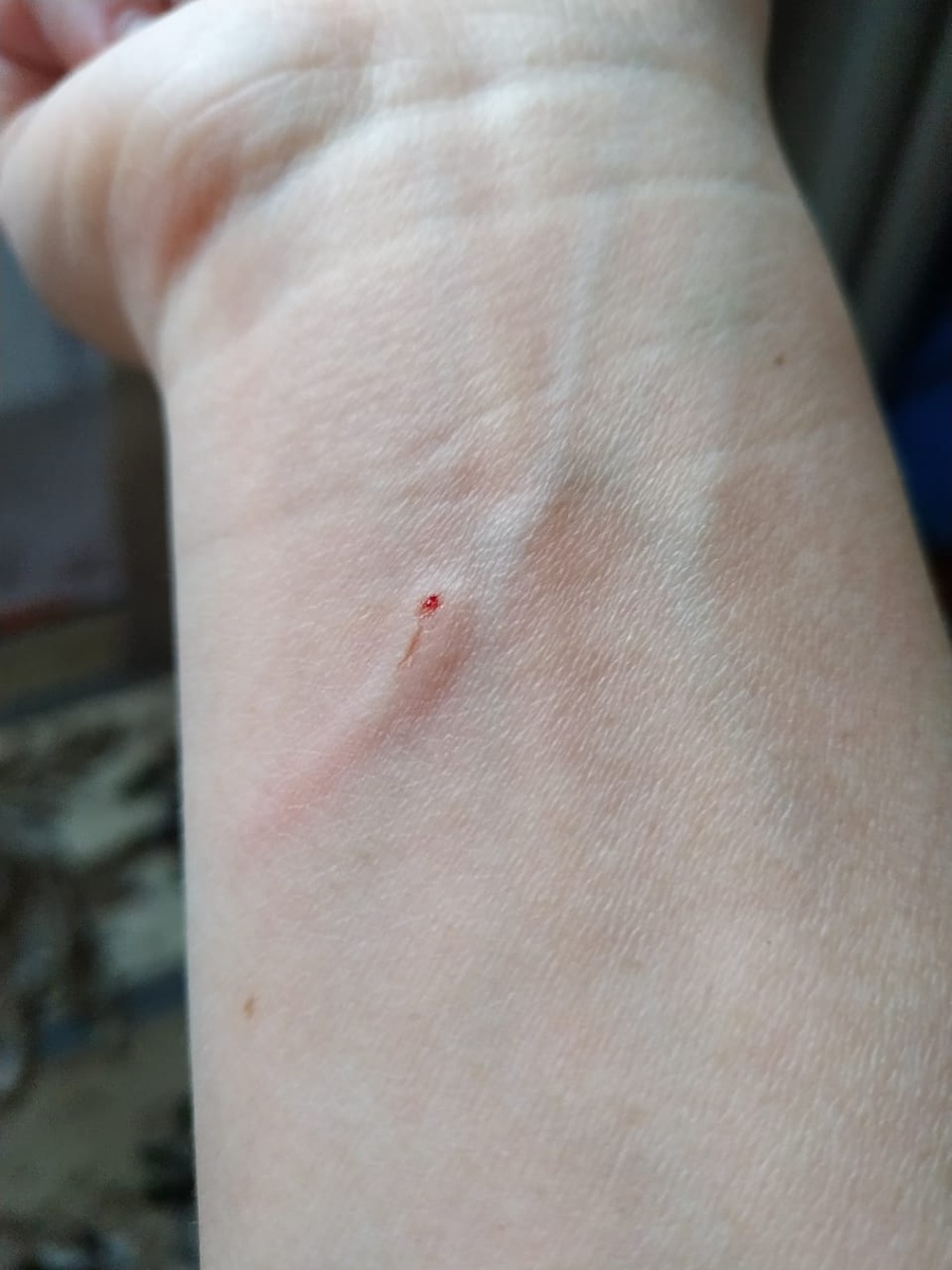 Вот такая дырка осталась на руке