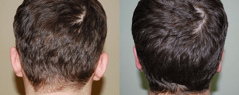 Фото до и после отопластики. Фото с сайта Д.Р. Гришкяна. Имеются противопоказания, требуется консультация специалиста