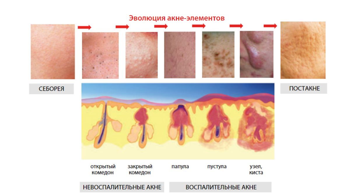 "Жирная кожа, акне и постакне в практике косметолога" Е.И. Эрнандес, стр. 11, рис. I-1. "Эволюции акне-элементов и стадии развития акне"  
