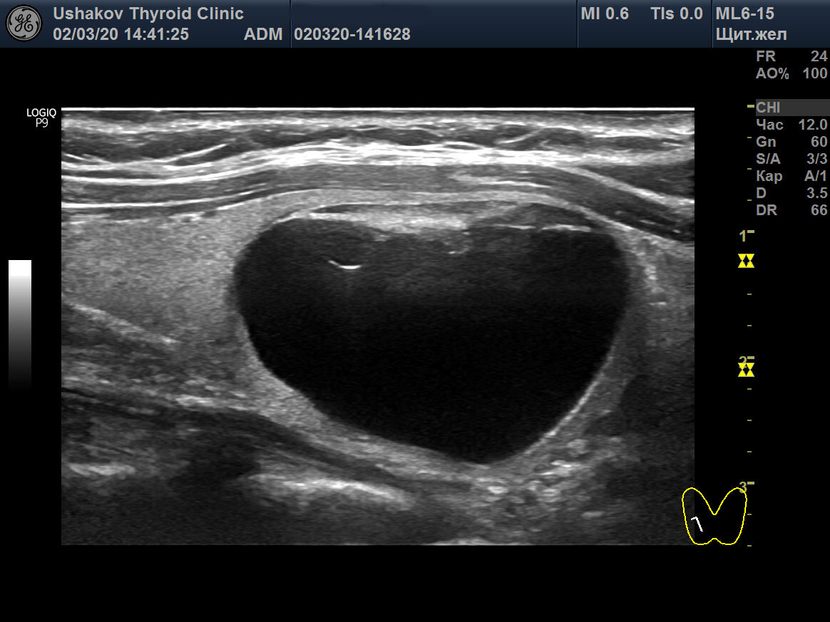 Кистозный узел (киста) щитовидной железы. Рисунок из атласа-руководства А.В. Ушакова "Ультразвуковая диагностика рака щитовидной железы по ACR TI-RADS", 2020