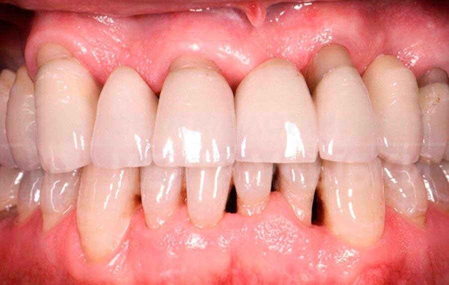 Для пародонтита характерна отечность, кровоточивость и краснота десен. Длительно протекающий воспалительный процесс приводит к потере зубов.