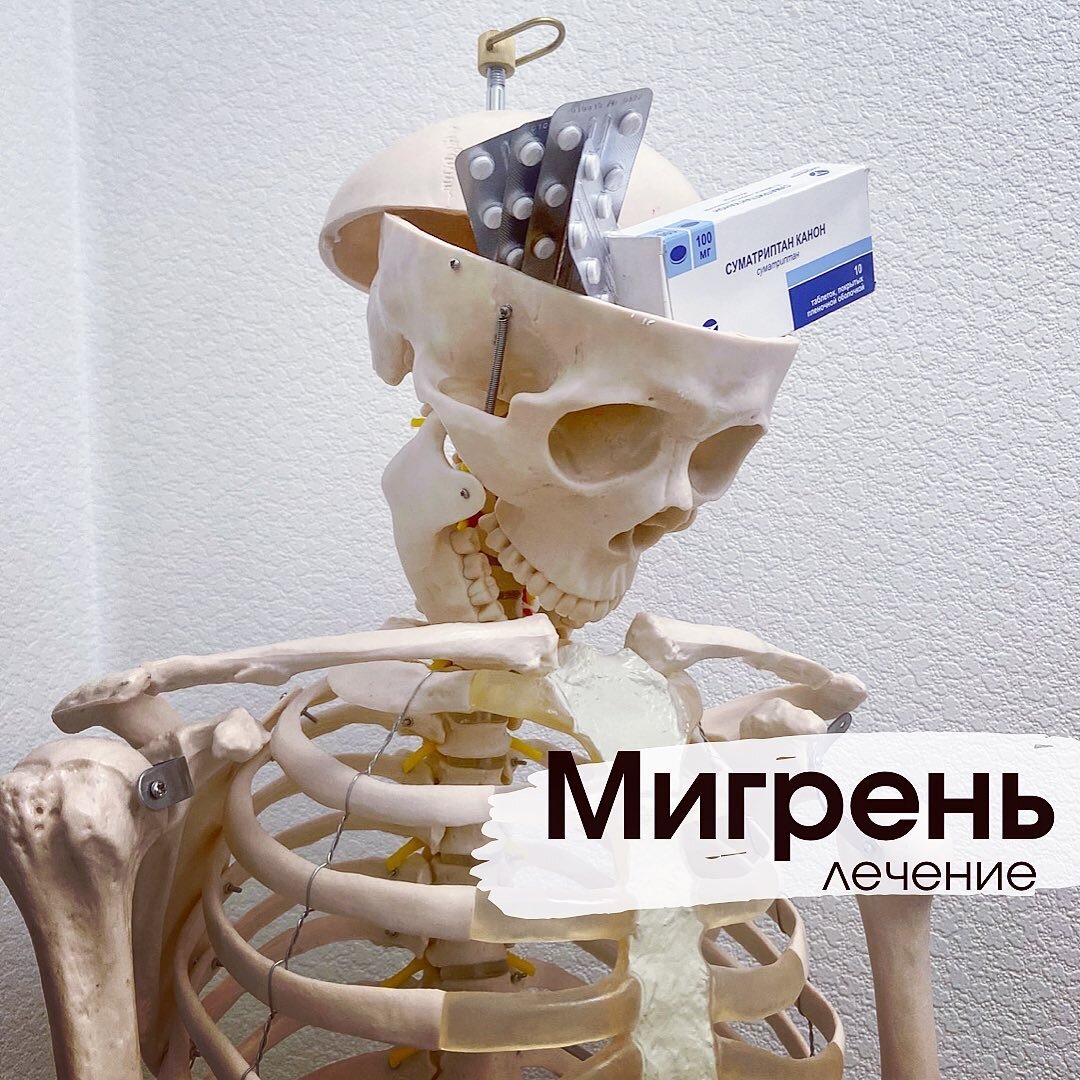 Мигрень: симптомы, причины, лечение