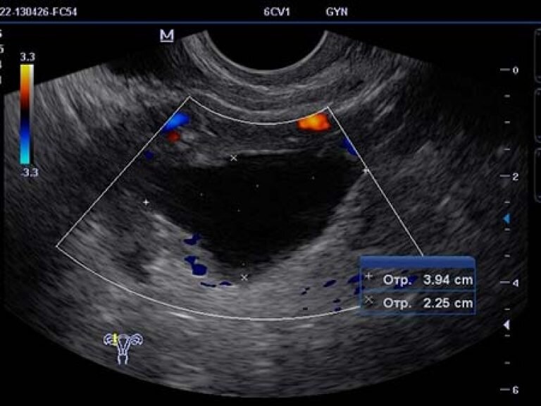 Гидросальпинкс узи картина