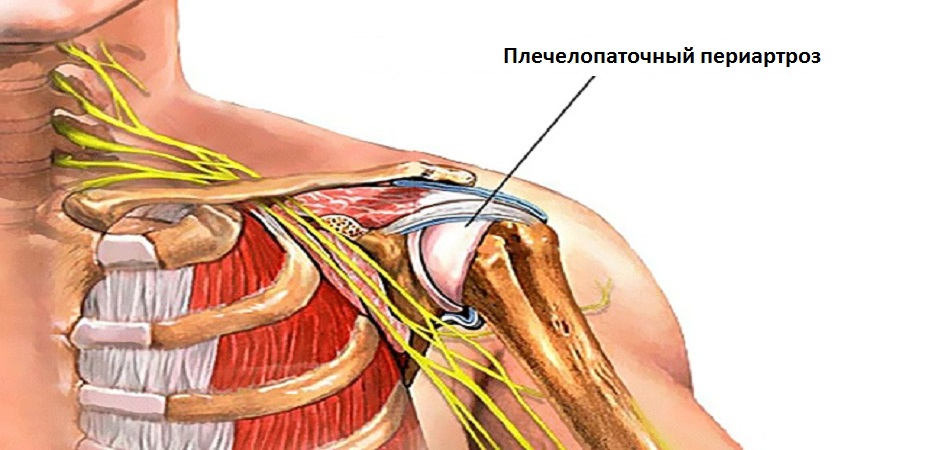 Периартрит левого