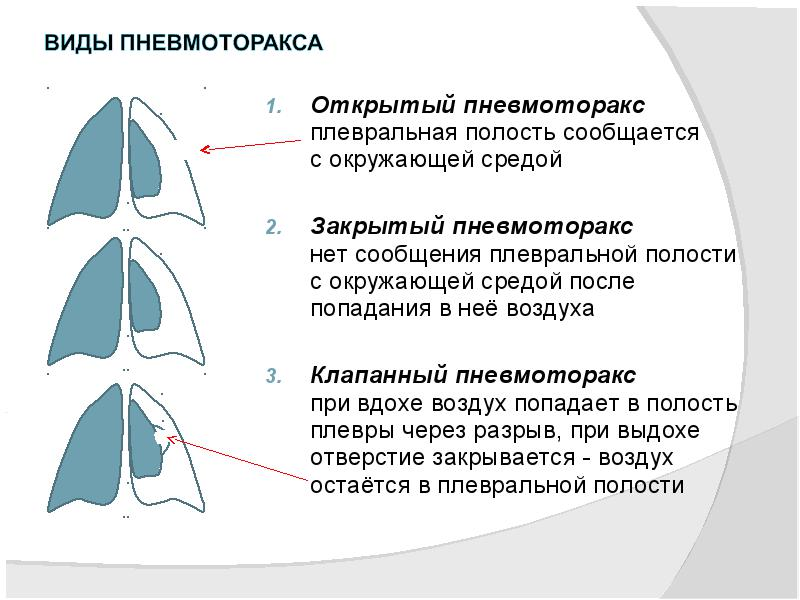 Представлено дополнительное описание видов пневмоторакса. 