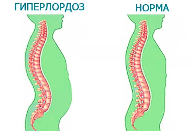 Какими упражнениями вернуть осанку если у вас гиперлордоз и что такое гиполордоз