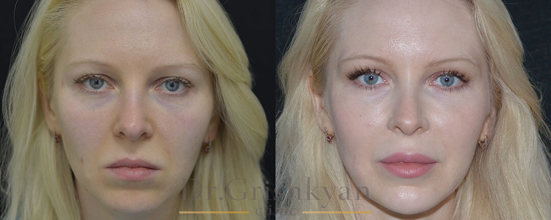 Липофилинг лица фото до и после. Фото с сайта Д.Р. Гришкяна. Имеются противопоказания, требуется консультация специалиста
