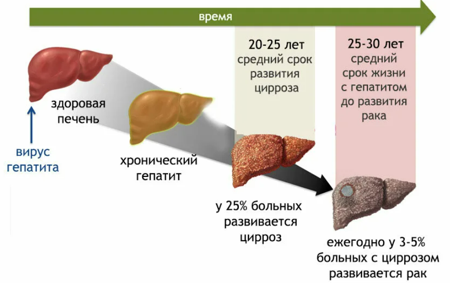 Состояние печени. Гепатит б (легкая степень). Стадии хронического гепатита.