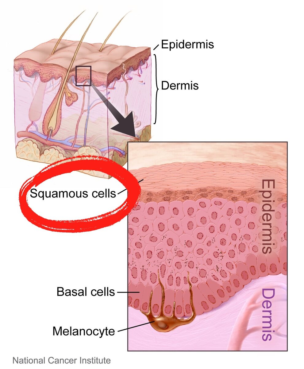 Squamous cell — плоские клетки (кератиноциты)