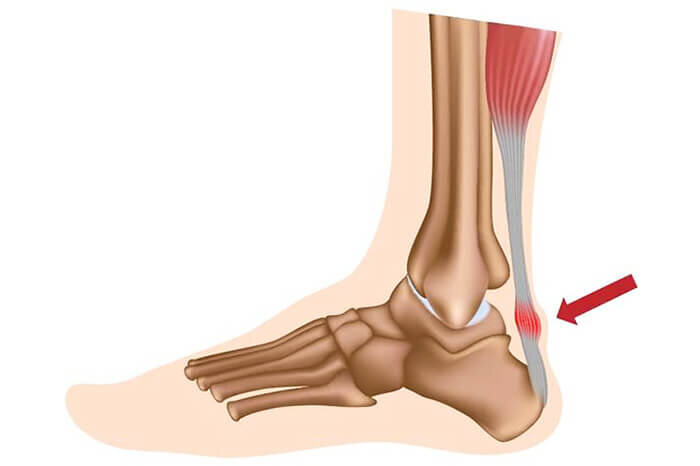 Тенденит ахиллова сухожилия