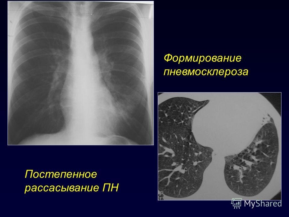 Пневмосклероз легких что это такое. Постпневмонический пневмосклероз. Диффузный пневмофиброз кт. Очаговый пневмосклероз рентген. Постпневмонический пневмосклероз симптомы.