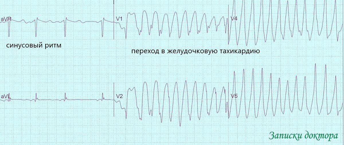 желудочковая тахикардия