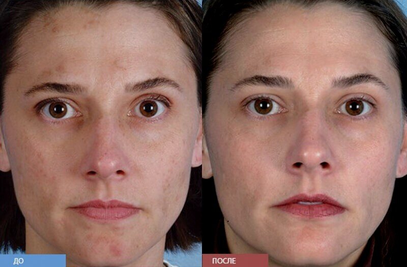 Кожа становится более мягкой и эластичной, выравниваются неровности кожи, клетки быстрее обновляются.