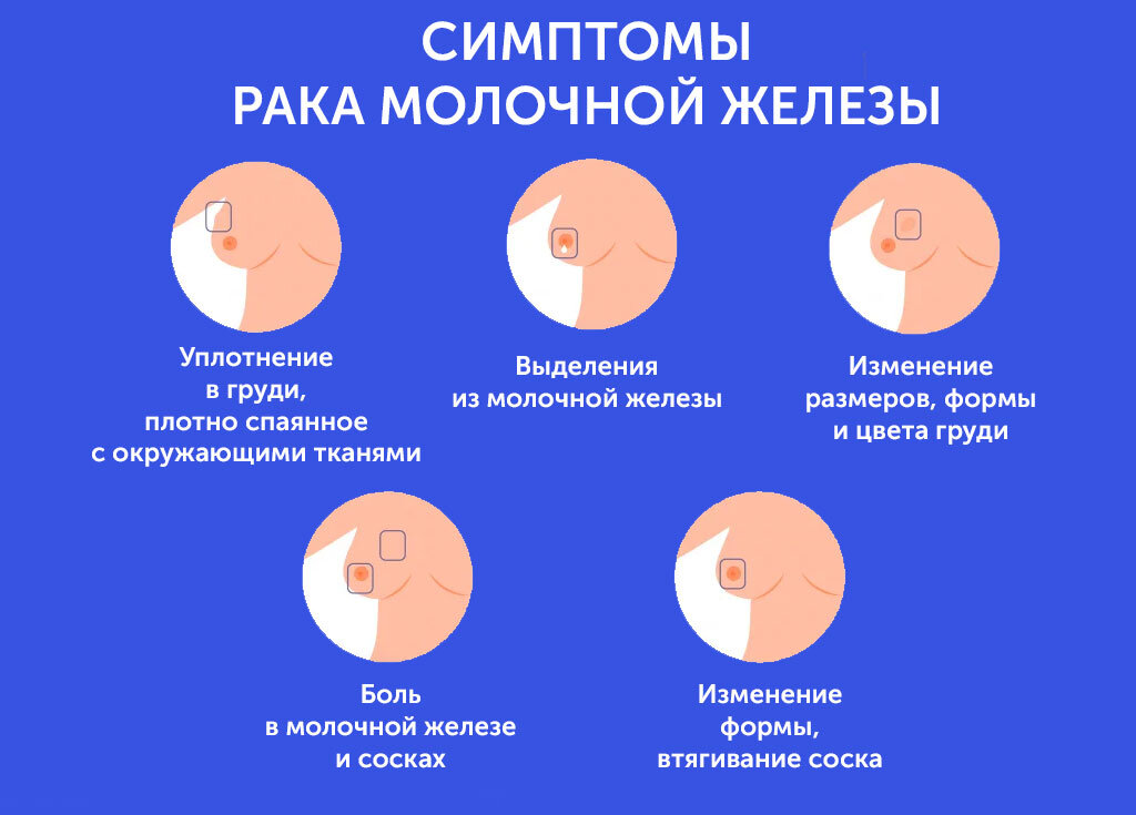 Симптомы рака молочной железы