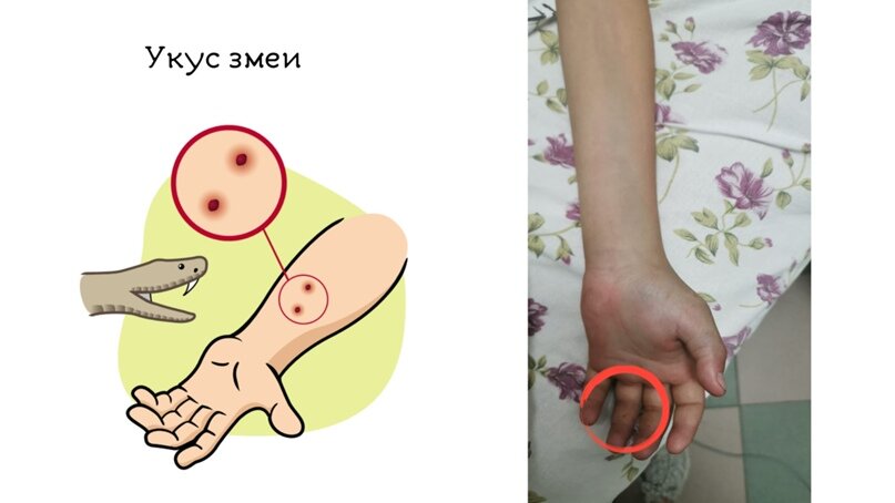 Место укуса гадюкой обыкновенной