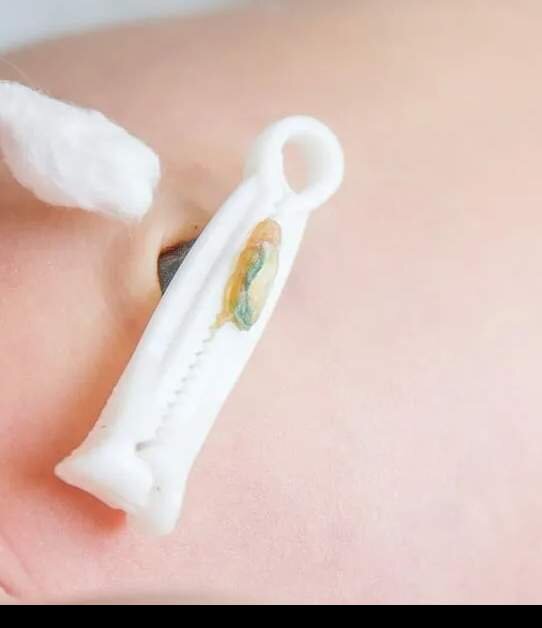 Пупок с прищепкой