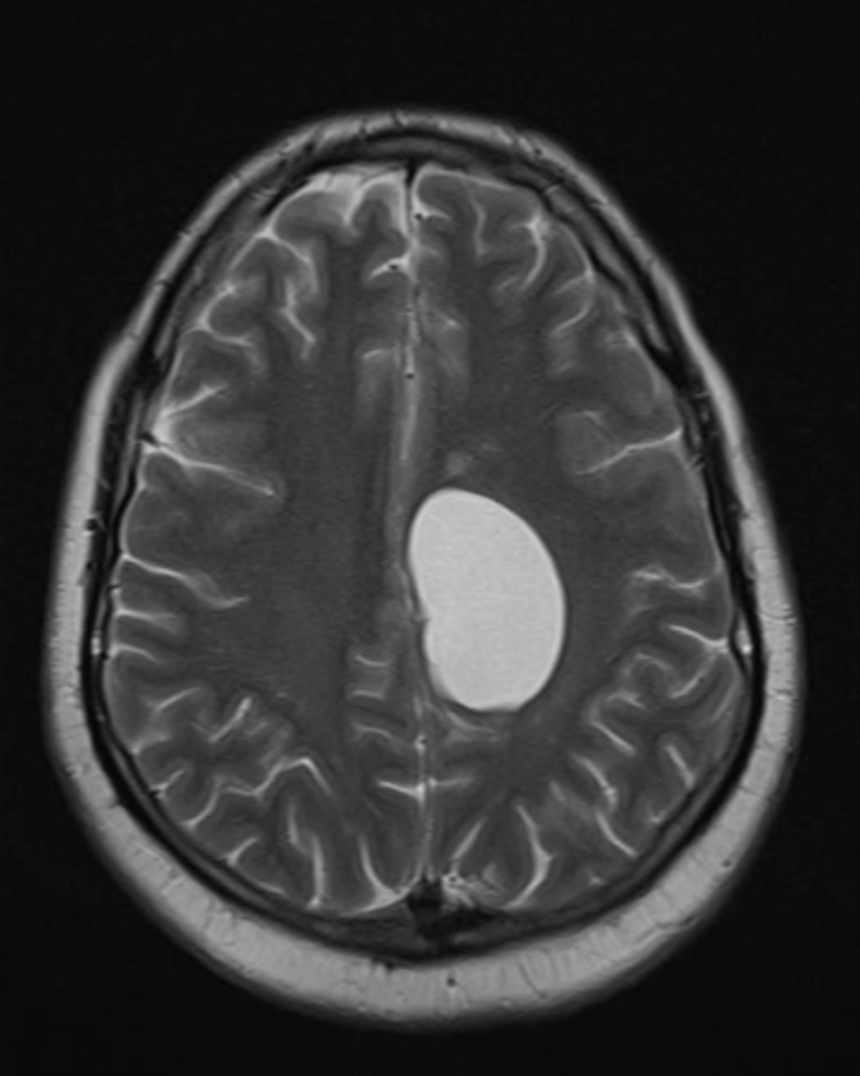 Киста на МРТ головного мозга | Общегородской центр записи | Дзен